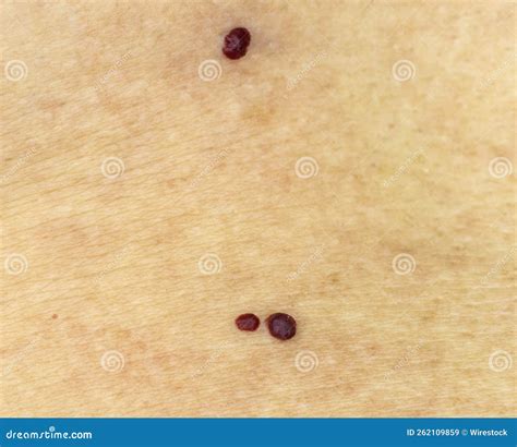 Red Mole On Skin
