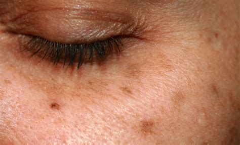 What Are Age Spots? | Healthy Anti-Aging Group