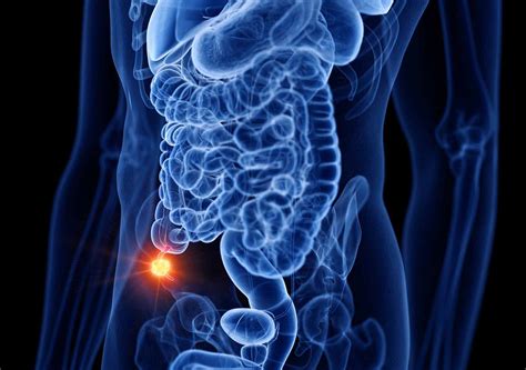 Expert Appendicitis Treatment by Dr. Mahmoud Tabbal - Appendicitis Specialist Dubai