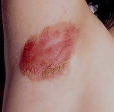 Herbal Psoriasis Treatment & Counselling Clinic