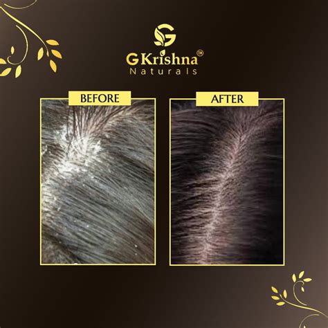 Advanced Anti-Dandruff Kit – GK Naturals