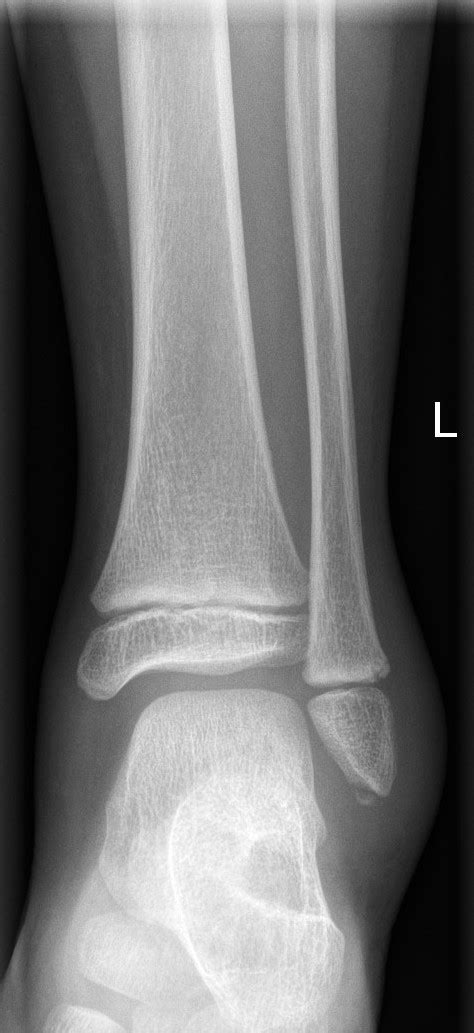Fractures - Ankle