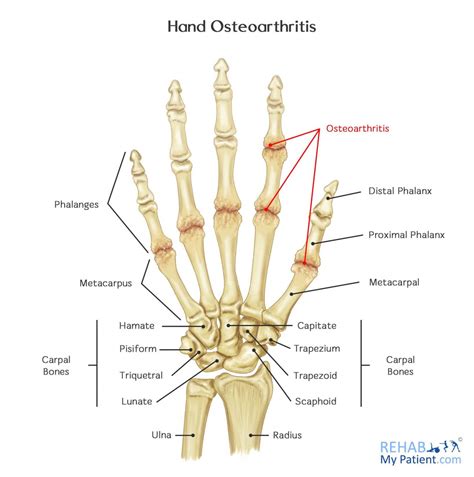 Hand Osteoarthritis | Rehab My Patient
