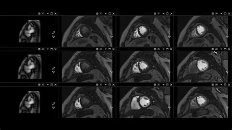 Philips - CardiacQuant Perfusion MR Clinical Applications - Philips