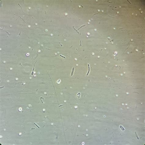 Hyaline Casts: Identification & Clinical Significance - MedLabBuddy
