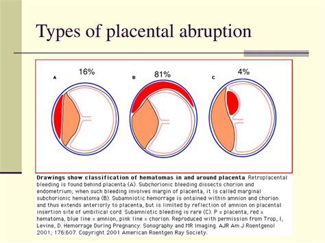 PPT - Understanding Placenta Previa & Abruption: Types, Risk Factors ...