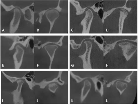 Cone-Beam CT-Based Analysis of Temporomandibular Joint Osseous Changes ...