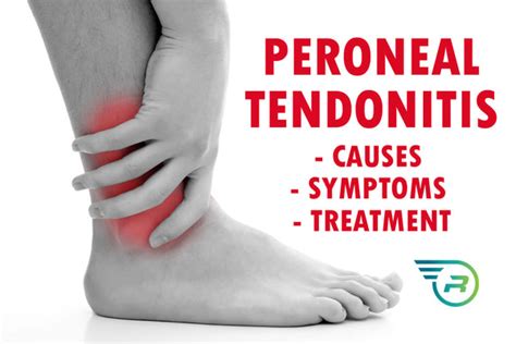 Can You Treat Peroneal Tendonitis with Compression Socks? - Run Forever ...