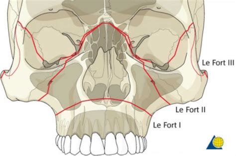 A Dental Student's Guide to...Le Fort fractures - Dentistry