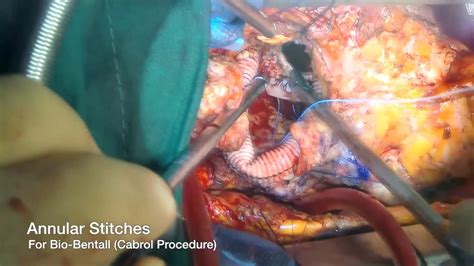 Redo aortic root replacement (Cabrol procedure) and Commando operation ...