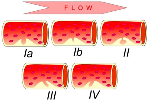 Advances in Noninvasive Carotid Wall Imaging with Ultrasound: A ...