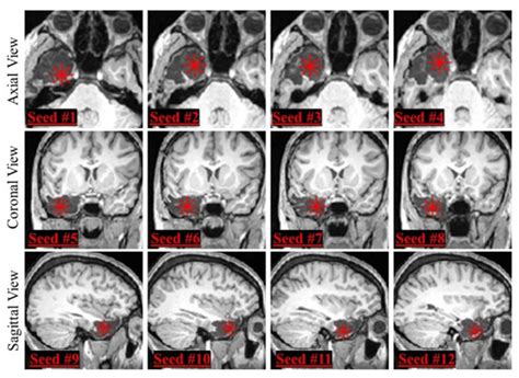 Diagnostics | Special Issue : Brain Imaging in Epilepsy