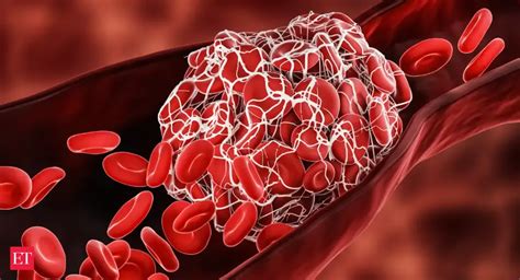 “Blood clots can strike anywhere — leg, arm, heart, or lung”—the ...