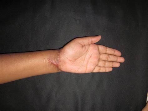 SHARP CUT INJURY WRIST - MEDIAN NERVE INJURY - MULTIPLE FLEXOR TENDON ...