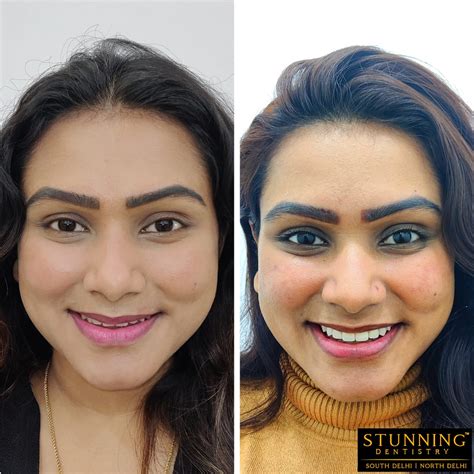 Stunning Dentistry | Dental Cases Portfolio | Smile Gallery