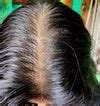 Hair Loss Treatment for Women - Holistic Hair fall Solutions for ...