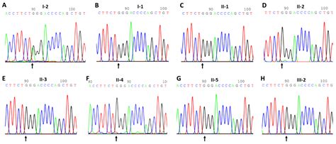 The ENG/VEGFα Pathway Is Likely Affected by a Nonsense Variant of ...