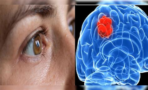 आंखों से लगा सकते हैं ब्रेन ट्यूमर का पता, Dr. Ajay Chaudhary से जानिए ...