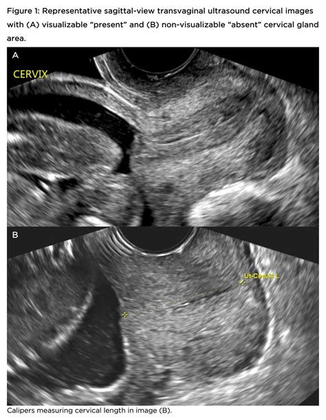 Transvaginal Ultrasound Cervix