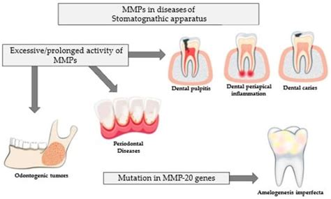 Importance of Metalloproteinase 8 (MMP-8) in the Diagnosis of Periodontitis