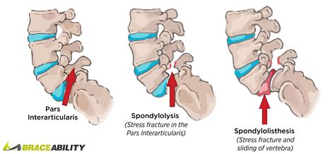 Spondylolysis Treatment
