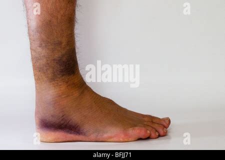 Swelling and Bruising of the Ankle Stock Photo: 7710670 - Alamy