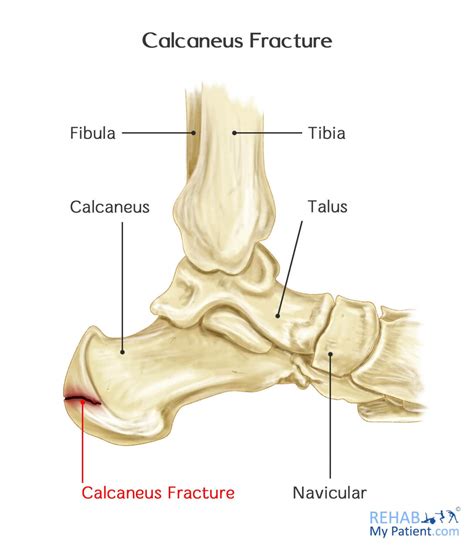 Calcaneus Fracture | Rehab My Patient