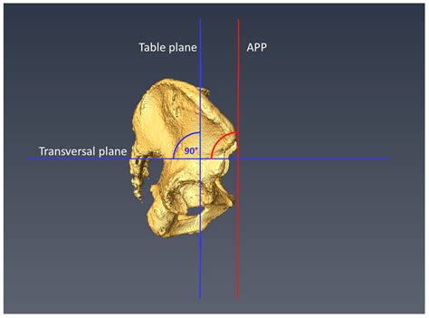 Lumbosacral Transitional Vertebrae Influence on Acetabular Orientation and Pelvic Tilt