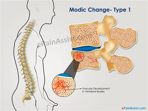 What are Modic Changes and How is it Treated - Know its Significance on Back Pain