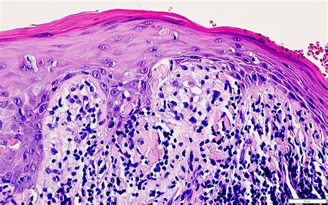 Erosive Lichen Planus Histology