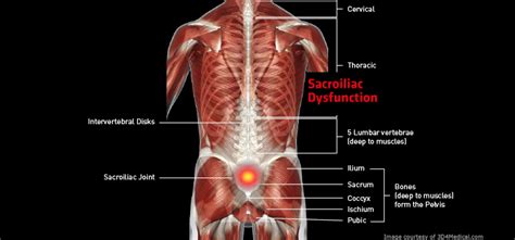 Sacroiliac Dysfunction (Inflammation of the Sacroiliac Joint ...