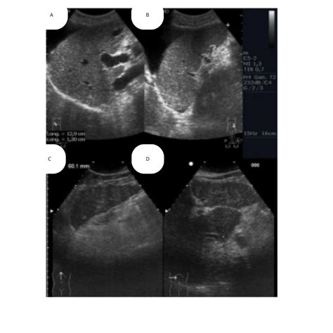 Daño Hepático Crónico: Hallazgos Ecográficos Importantes en Hepatopatía ...