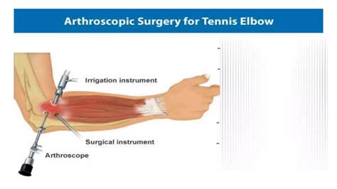 Tennis Elbow Surgery