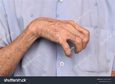 Volkmanns Contracture