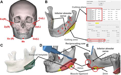 Current Practices for Esthetic Facial Bone Contouring Surgery in Asians - Clinics in Plastic Surgery