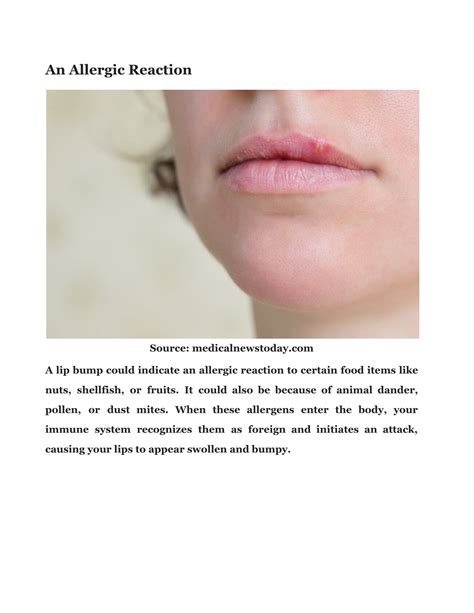 PPT - Bump On Lip: Check Out The Causes And Its Treatment PowerPoint Presentation - ID:11400451