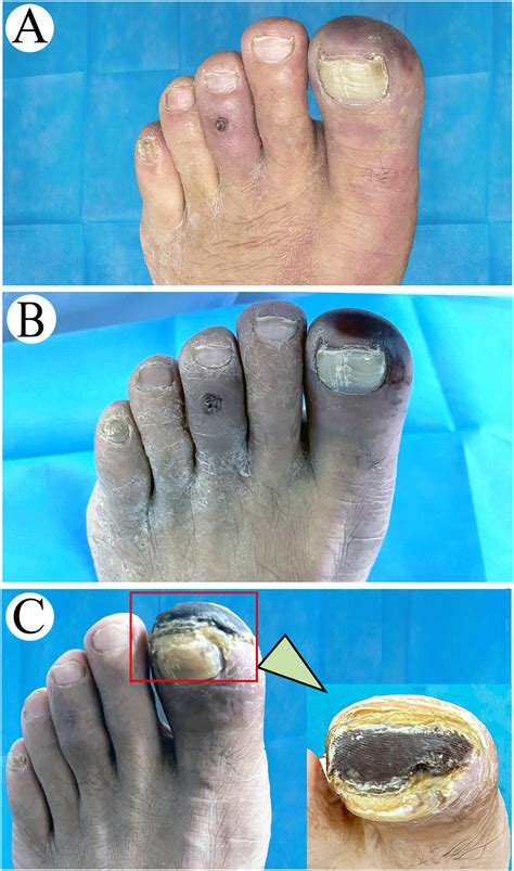 The Evolution of Blue Toe Syndrome in a Diabetic Patient - The American Journal of Medicine
