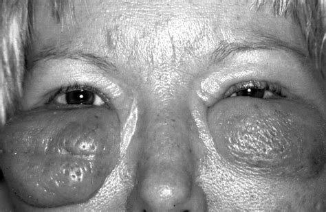 Grotesque bilateral eyelid swelling as a symptom of Munchausen's syndrome | British Journal of ...