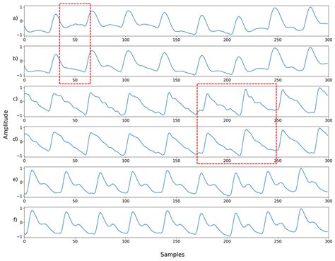Preeminently Robust Neural PPG Denoiser