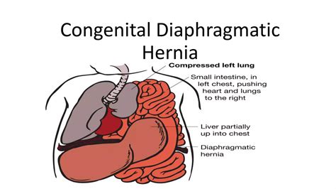 Congenital diaphragmatic hernia | PPTX