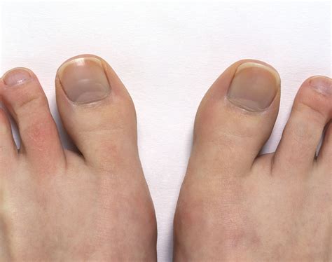 Symptoms of Arthritis of the Big Toe (Hallux Rigidus)
