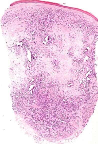 Dermatopathology Society of India: Image of the Month