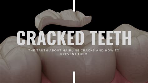 Cracked Teeth: The Truth About Hairline Cracks and How to Prevent Them - Eastern Idaho Endodontics