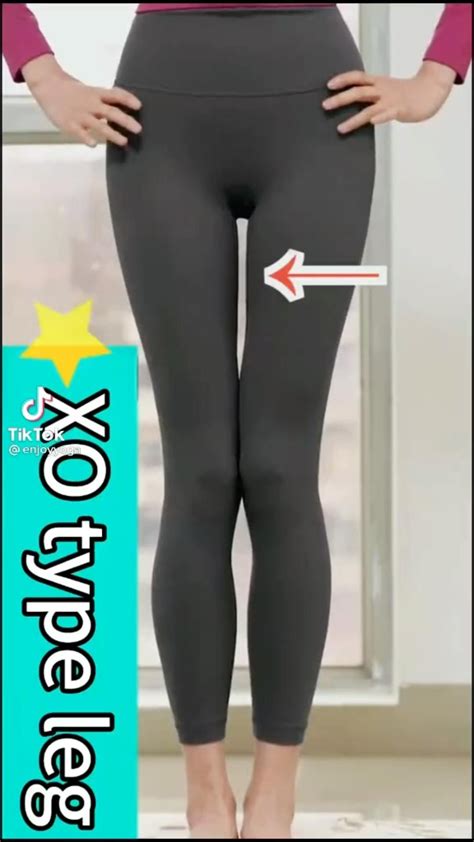 How to fix knocked knees genu valgum with correction exercises youtube – Artofit