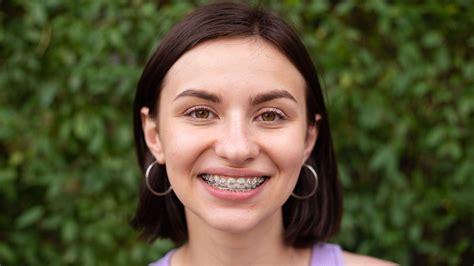 Metal Braces for Teeth: A Complete Guide