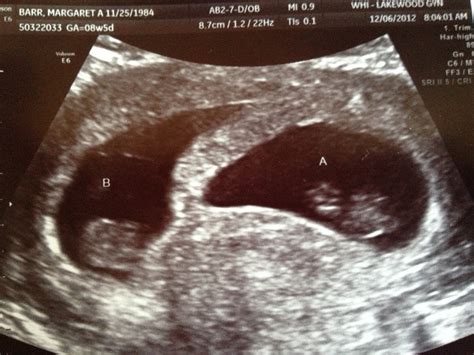 5 Week Sonogram