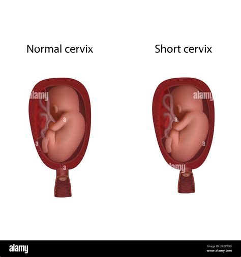 Short cervix and normal cervix in pregnancy, illustration Stock Photo ...