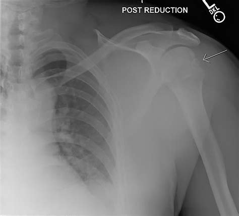 Hill-Sachs defect • LITFL • Medical Eponym Library - Face Surgery