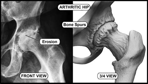 ~ Arthritic Hips & Knees Images – Hip and Knee Handbook of Joint ...