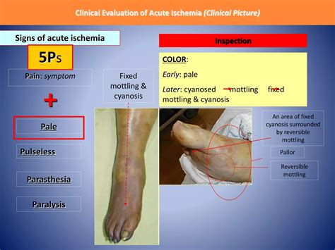 Acute Limb Ischemia - Emergency Case presentation | PPTX